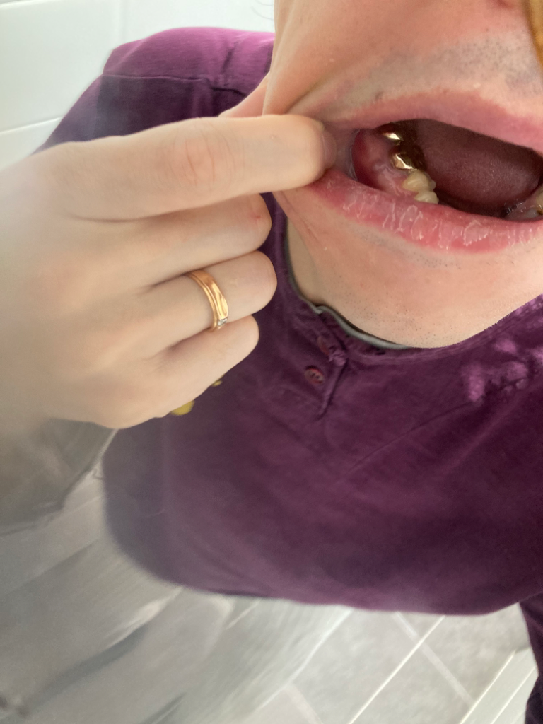 치은염의 고름에 대처하는 방법 7