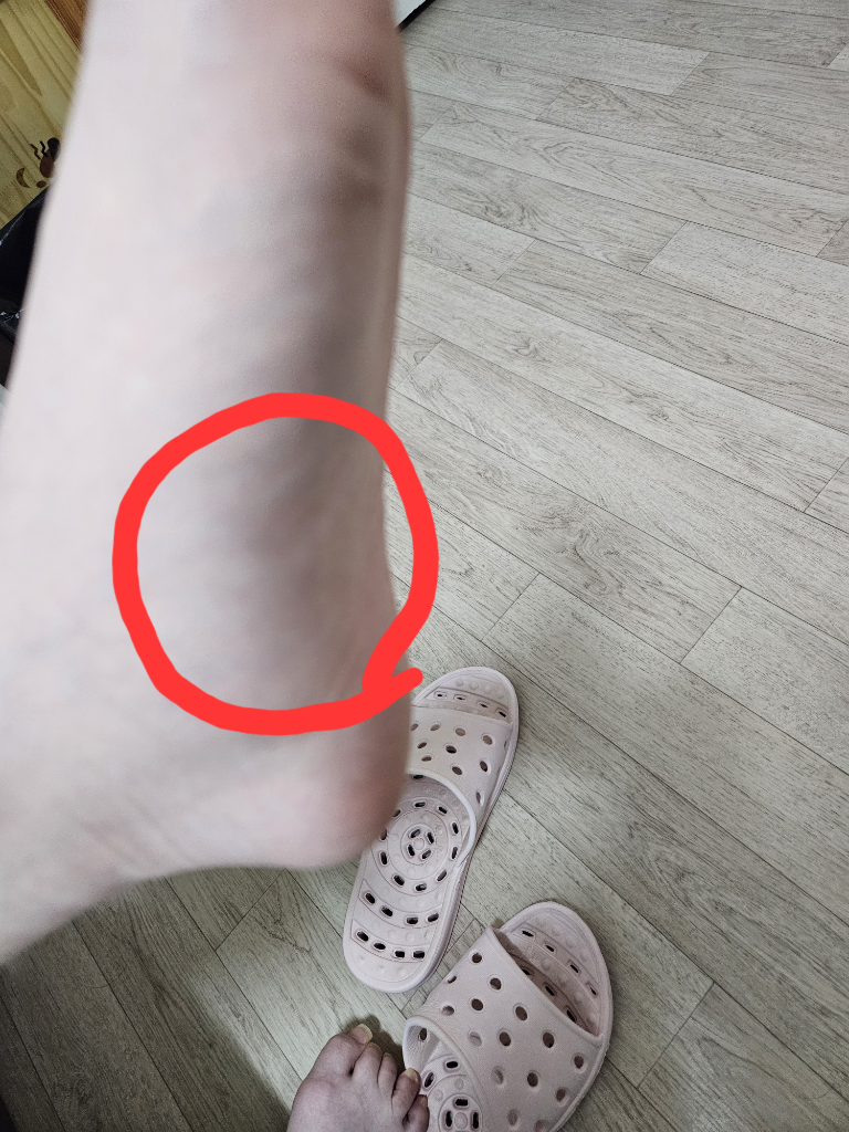 발바닥이 붓고 통증이 있습니다 ㅣ 궁금할 땐, 아하!