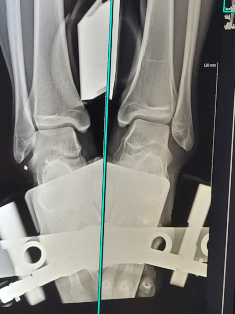 발목인대 파열 스트레스뷰 어디가 벌어진건가요? ㅣ 궁금할 땐, 아하!